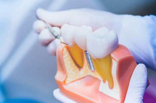 Dental Implants Hungary Helvetic Clinics