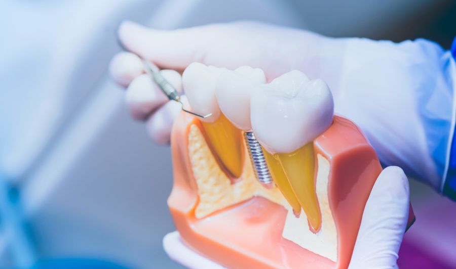 Dental Implants Hungary Helvetic Clinics